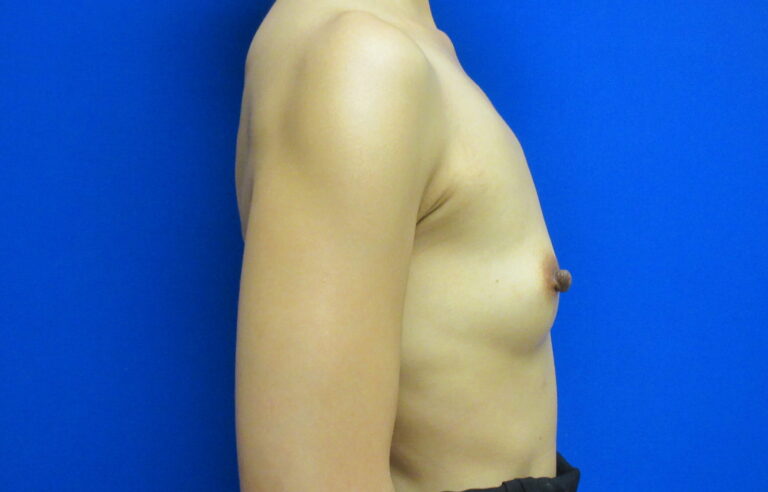 Before Image: Breast Augmentation Patient 166 - right-side
