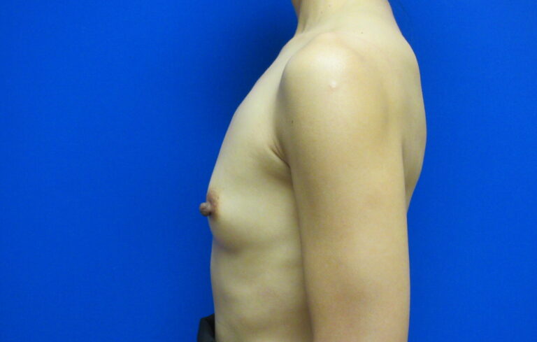 Before Image: Breast Augmentation Patient 166 - left-side