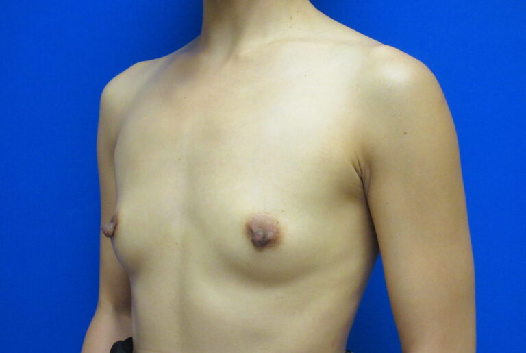 Before Image: Breast Augmentation Patient 166 - left-front-oblique