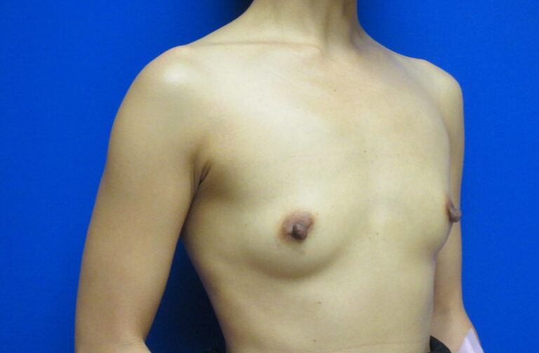 Before Image: Breast Augmentation Patient 166 - right-front-oblique