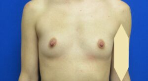 Before Image: Breast Augmentation Patient 167