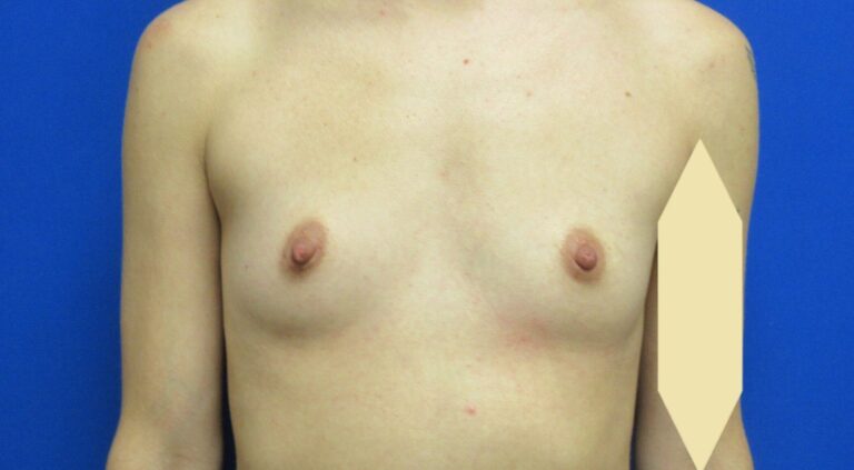 Before Image: Breast Augmentation Patient 167 - front