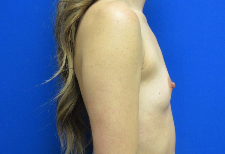 Before Image: Breast Augmentation Patient 167 - right-side