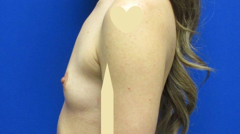 Before Image: Breast Augmentation Patient 167 - left-side