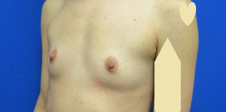 Before Image: Breast Augmentation Patient 167 - left-front-oblique