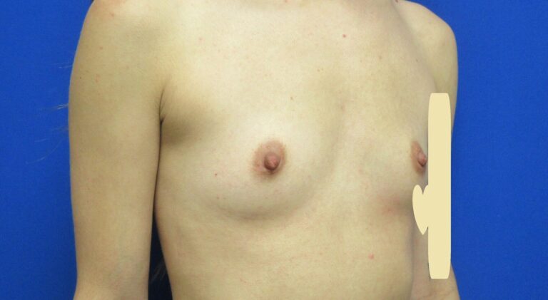 Before Image: Breast Augmentation Patient 167 - right-front-oblique