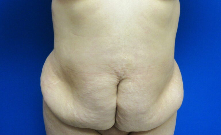 Before Image: Tummy Tuck Patient 61 - front
