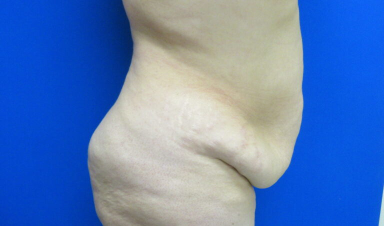 Before Image: Tummy Tuck Patient 61 - right-side