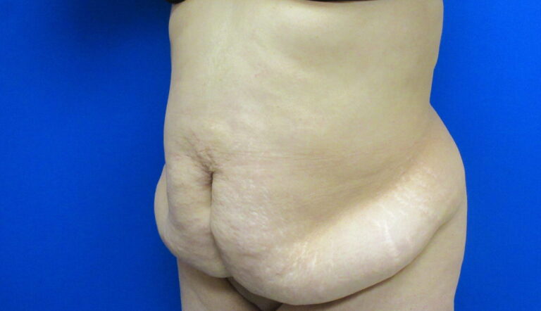 Before Image: Tummy Tuck Patient 61 - left-front-oblique