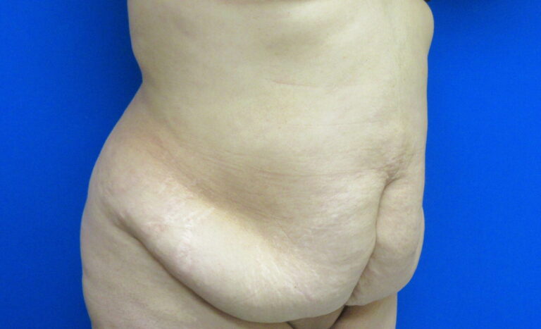 Before Image: Tummy Tuck Patient 61 - right-front-oblique