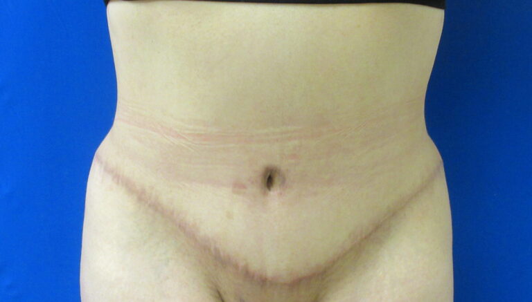 After Image: Tummy Tuck Patient 61 - front