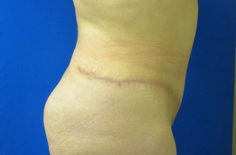 After Image: Tummy Tuck Patient 61 - right-side