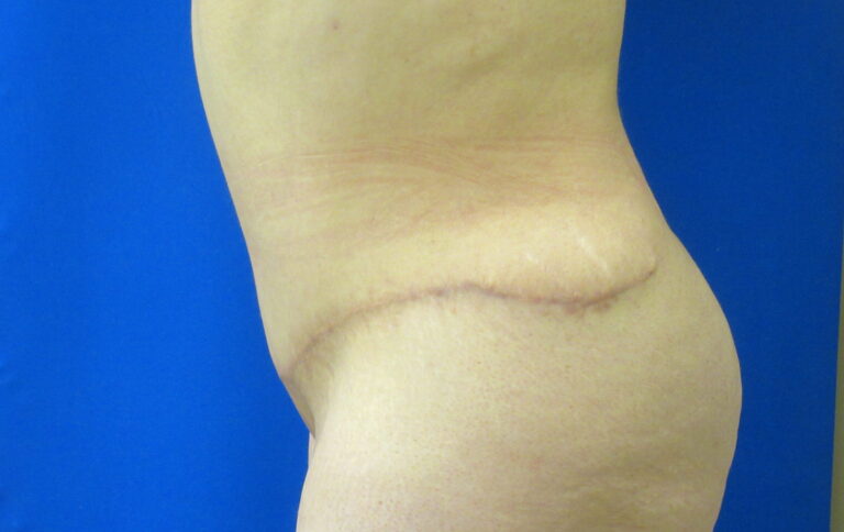 After Image: Tummy Tuck Patient 61 - left-side