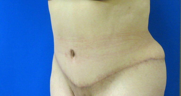 After Image: Tummy Tuck Patient 61 - left-front-oblique