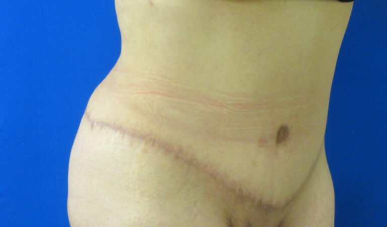 After Image: Tummy Tuck Patient 61 - right-front-oblique