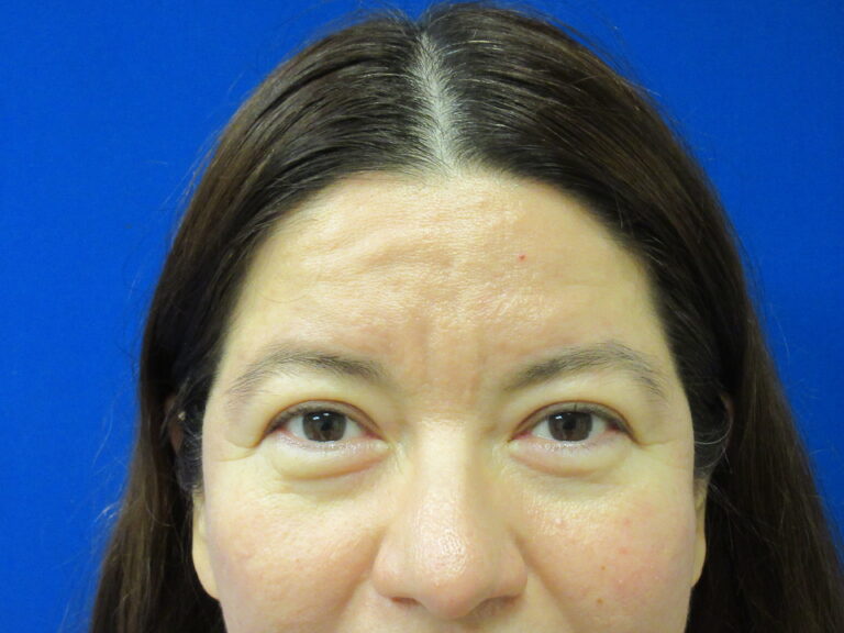 Before Image: Blepharoplasty Patient 14 - front