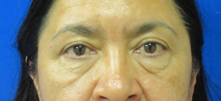 Before Image: Blepharoplasty Patient 13 - front