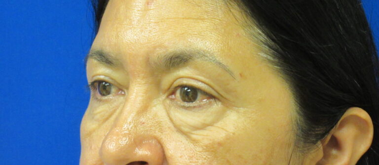 Before Image: Blepharoplasty Patient 13 - left-front-oblique