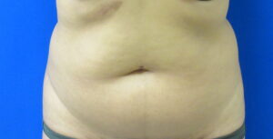 Before Image: Liposuction Patient 19