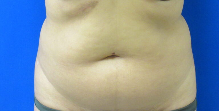 Before Image: Liposuction Patient 19 - front
