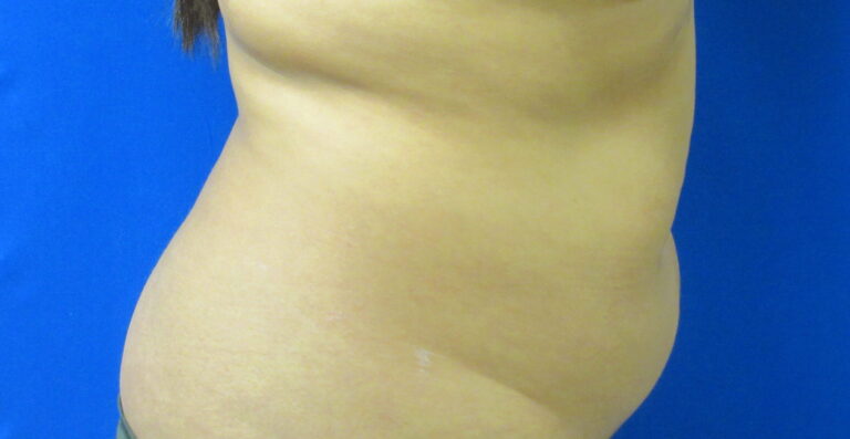 Before Image: Liposuction Patient 19 - right-side