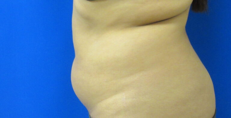 Before Image: Liposuction Patient 19 - left-side