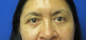 After Image: Blepharoplasty Patient 13