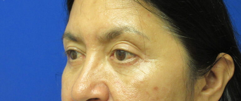 After Image: Blepharoplasty Patient 13 - left-front-oblique