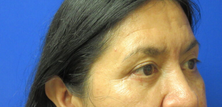 After Image: Blepharoplasty Patient 13 - right-front-oblique