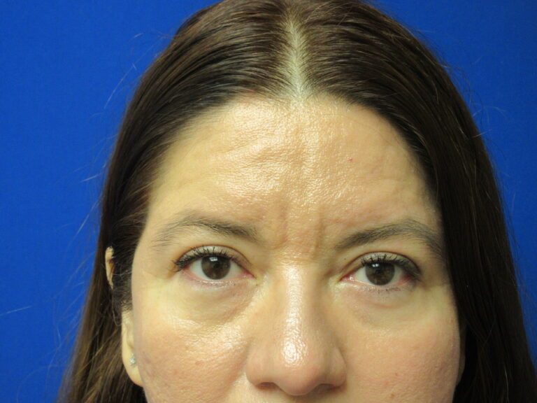 After Image: Blepharoplasty Patient 14 - front