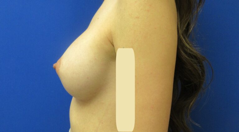 After Image: Breast Augmentation Patient 167 - left-side