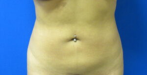 After Image: Liposuction Patient 19