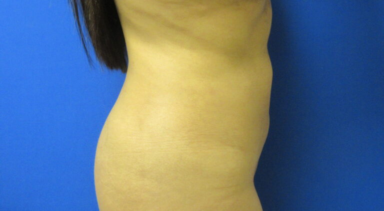 After Image: Liposuction Patient 19 - right-side