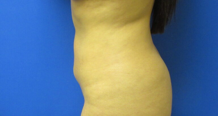 After Image: Liposuction Patient 19 - left-side