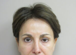 Before Image: Browlift Patient 5