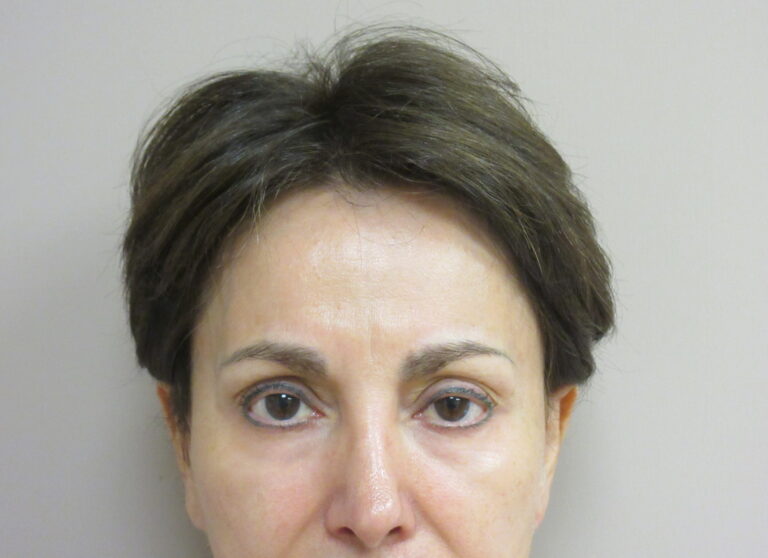 Before Image: Browlift Patient 5 - front