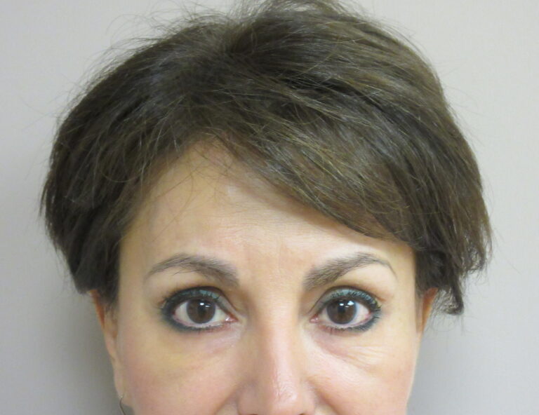 After Image: Browlift Patient 5 - front