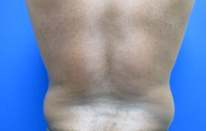 Before Image: Liposuction for Men Patient 8