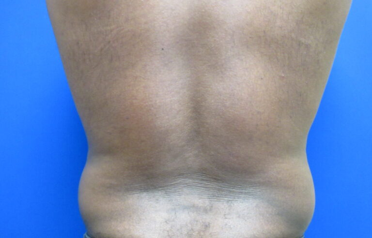 Before Image: Liposuction for Men Patient 8 - back