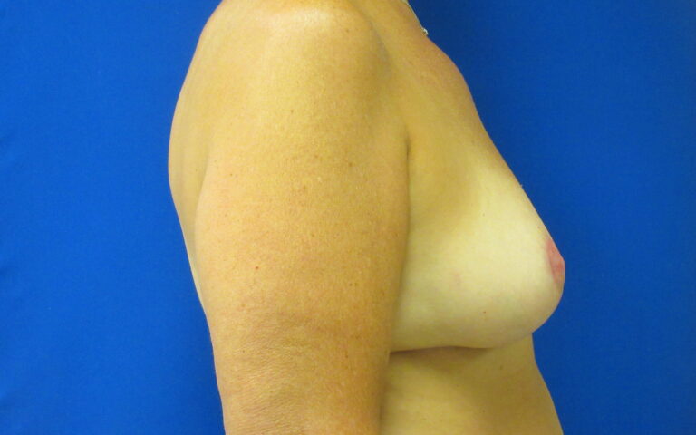 After Image: Breast Reduction Patient 22 - right-side