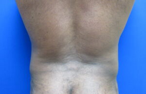 After Image: Liposuction for Men Patient 8