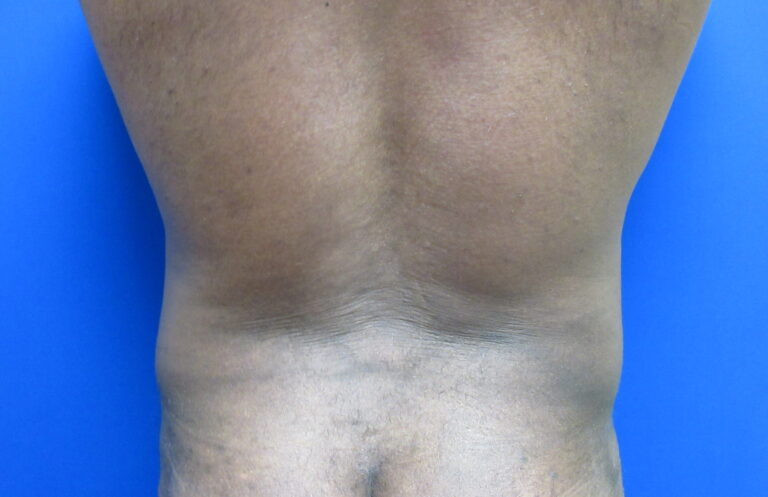 After Image: Liposuction for Men Patient 8 - back
