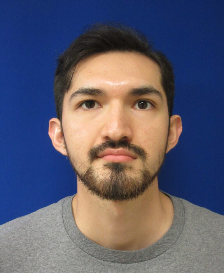 Before Image: Otoplasty Patient 6 - front