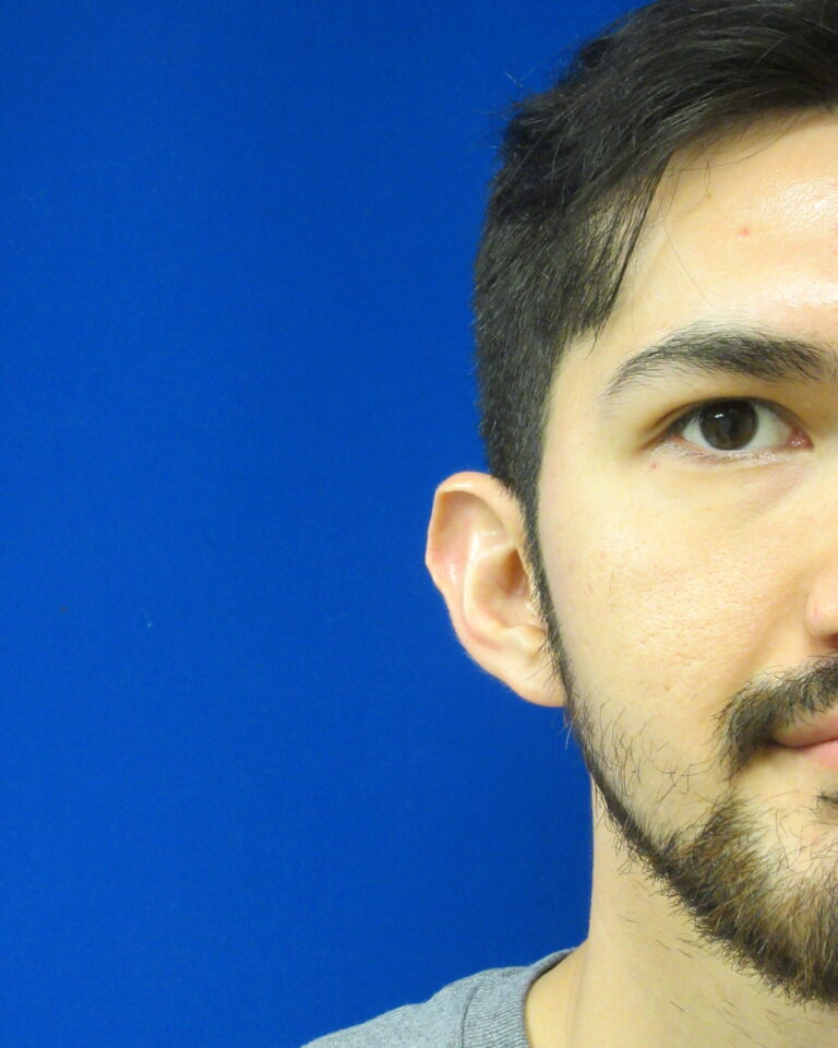 Before Image: Otoplasty Patient 6 - front