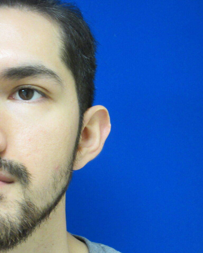 Before Image: Otoplasty Patient 6 - front