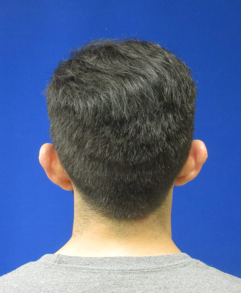 Before Image: Otoplasty Patient 6 - back