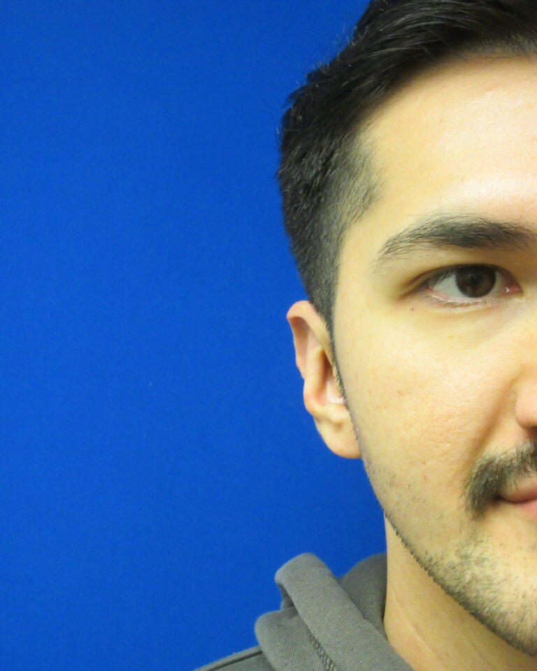 After Image: Otoplasty Patient 6 - front