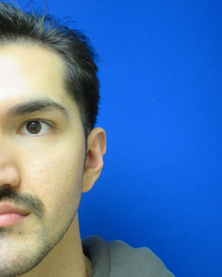 After Image: Otoplasty Patient 6 - front