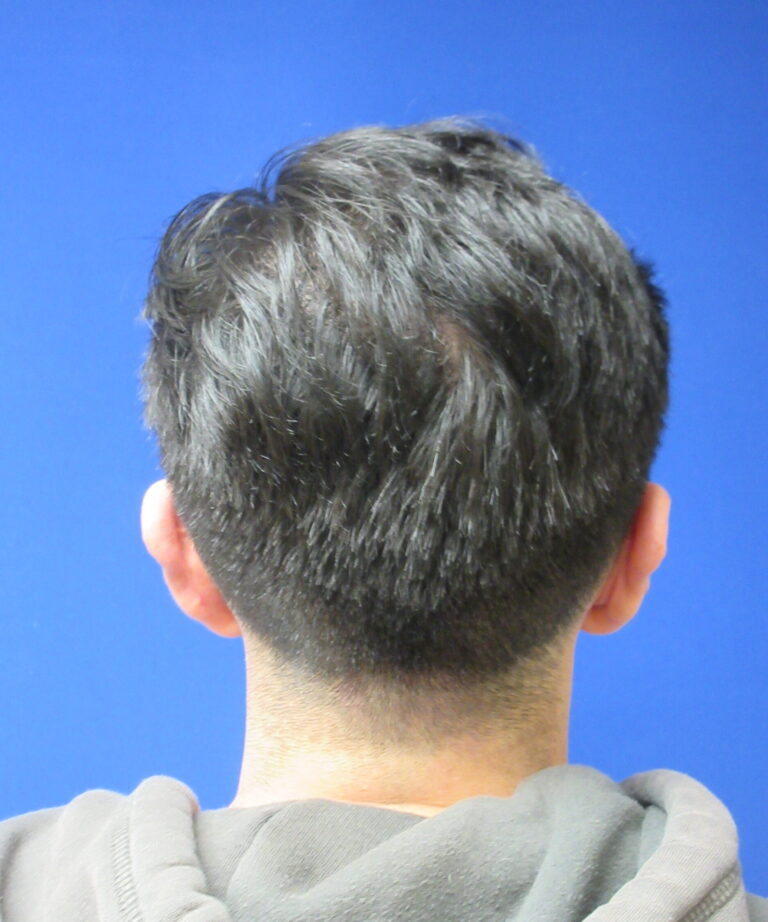 After Image: Otoplasty Patient 6 - back