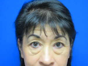 Before Image: Blepharoplasty Patient 15